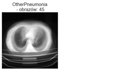 Średnie obrazy poszczególnych katalogów klasy OtherPneumonia - zbiór walidacyjny