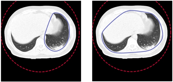 Przykład obrazu, dla którego active contour nie obejmuje płuc i poprawiony obraz po zwiększeniu liczby punktów w początkowym okręgu