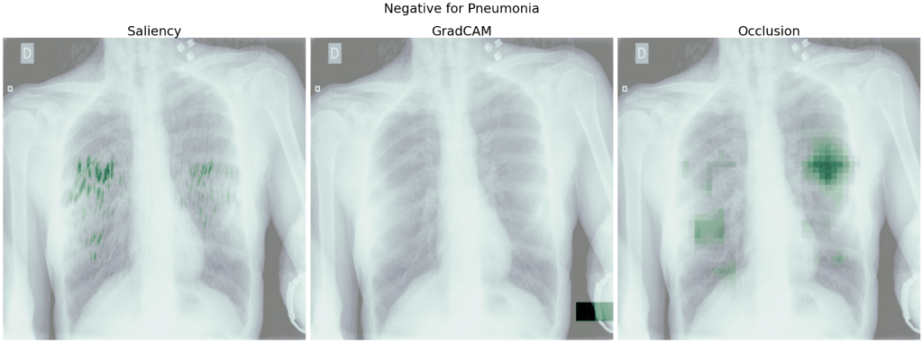 Heatmapy obrazu Negative for Pneumonia - wyniki Salincy, GradCAM i Occlusion